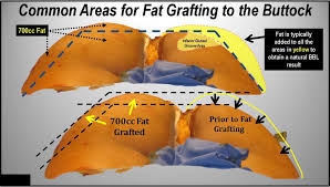 Creating The Ideal Buttock Lifting Implanting Or Fat