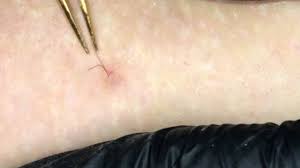 This clogging can force a hair to grow sideways (ouch), but regular exfoliation (once a week) will help prevent that build up of dead skin cells on the surface of the skin. Ingrown Hair Removal Youtube