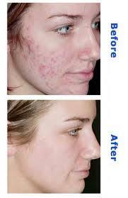 Pin On Acne Treatment