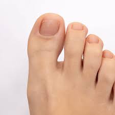 Image result for Clubbing nails feet
