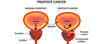 Despite this, pancreatic cancer is among the deadliest types of cancer, which is why it's extremely important to know and recogni. Prostate Cancer Treatment In Greater Noida Best Urologist