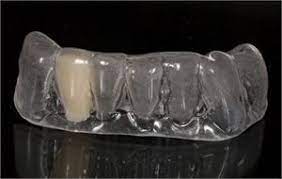 Invisible Retainer With A Fake Tooth To Fill Up The Gap And Restore The Missing Tooth In The Arch Essix Retainer Retainer Teeth Fake Teeth