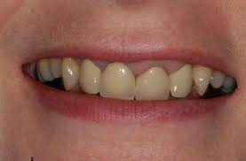 Revolutionary Orthodontic Treatments For Problem Gums