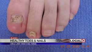Bioclear Nail Fungus Pen Reviews Lunula Laser Targets Nail Fungus Youtube
