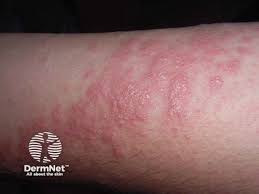 Image result for Photodermatitis