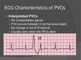 Ventricular Arrhythmias Ppt Download