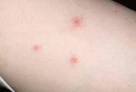 Bites And Infestations Pictures Of Bug Bites Stings Allergies And Infections