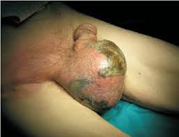 Fournier gangrene, also known as fournier's gangrene, is related to klebsiella pneumonia and calciphylaxis. Initial Presentation Of The Patient With Fournier S Gangrene Before Download Scientific Diagram