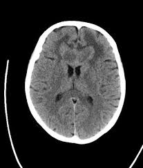 Primary Cns Lymphoma Radiology Case Radiopaedia Org Radiology Cns Radiology Imaging