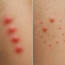 Image result for ant bite