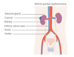 Cancer starts when cells in the body begin to grow out of control. Kidney Cancer Causes Diagnosis Treatment Myrtle Beach Sc