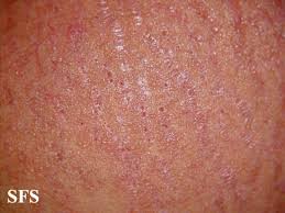 Image result for pruritic urticarial papules and plaques of pregnancy
