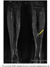 Image result for Tibia Stress Fracture