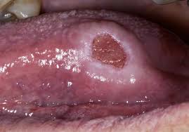 Image result for mouth ulcer on tongue)