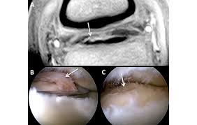 Hip flexor pain can also be a sign of a muscle or tendon tear. Deep Digital Flexor Tendon Injuries Does It Mean The End Of Your Horse S Career H H Vip Horse Hound