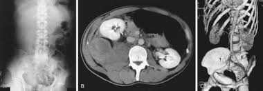 Image result for Factor IX Deficiency