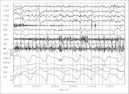Image result for Polysomnogram