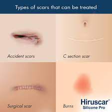 I bet you always seen their ads on how they are used to treat scars especially this one, for acne scars. Hiruscar Silicone Pro 10g Scar Removal Gel Shopee Malaysia