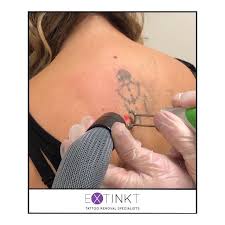 Suitable for a pay as you go approach to your tattoo removal. Extinkt Tattoo Removal Specialists Laser Tattoo Removal Sydney Facebook