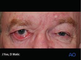 Image result for Pupillary Paralysis