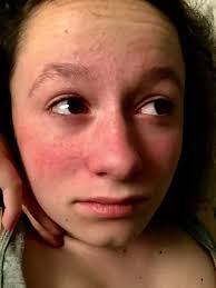 Girl, 15, who's 'allergic to everything' could be killed by a strong smell 