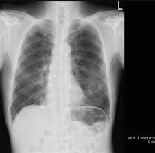 Unfortunately, this has a also been the prevailing position of the courts in england and wales, since 2007, when the house of lords ruled that pleural plaques was no longer an &quot;actionable injury&quot; Pleural Plaques As A Predictive Imaging Marker For Cancer Screening In Asbestos Exposed Subjects Can Pleural Plaques Be A Tool Beyond Estimating Past Asbestos Inhalation Springerlink