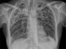Bacterial pneumonia is an infection of your lungs caused by certain bacteria. Pneumonia O Que E Causas Sintomas Tipos Tratamento Cura