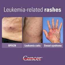 Maybe you would like to learn more about one of these? Skin Rashes And Leukemia What You Need To Know Md Anderson Cancer Center