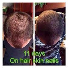 The second set of pictures shows that. Hair Skin Nails Vitamins Before After