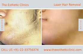 laser hair removal mumbai permanent