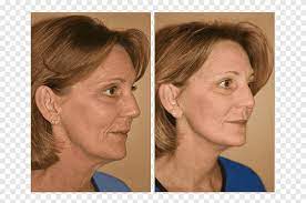 The ball waits on a path, and a spoon that rotates on an axis comes down, picks the ball up and drops it at the top. Cheek Rhytidectomy Lifestyle Lift Surgery Face Face Face People Png Pngegg