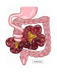Image result for Intestinal Malrotation