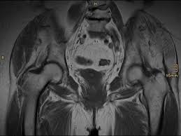 Zusätzlich schrägaufnahmen von 40 grad oben. Ukgm Giessen Marburg Mrt Des Beckens