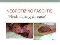 The bodily waste expelled by an #ostomy through the stoma is commonly referred to as the stomal output. Necrotizing Fasciitis Or Flesh Eating Disease