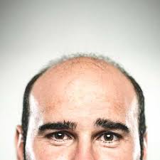 Learn more about other causes of baldness. Hair Loss And Testosterone