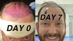 Hair Restoration
