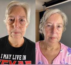 Ultra posable cat with cataracts treatment