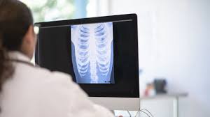 One of the most common signs of lung cancer in females is a cough that keeps deteriorating and doesn't go away. Lung Cancer In Nonsmokers Fact Sheets Yale Medicine