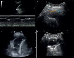 Ultrasound image of a large parapneumonic effusion shows thick septations (arrows) within the fluid, in keeping with an exudate. Thoracic Ultrasound In The Modern Management Of Pleural Disease European Respiratory Society