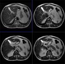 What do i do after my scan? Magnetic Resonance Imaging Preparations Abdomen Cedars Sinai