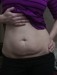 As men's health previously reported, liquids empty out of your stomach in less than an. Mom Belly Will I Ever Lose This Loose Skin Fat I Still Have Some Body Fat To Lose I M 5 9 And Around 150 Lb I Had My Last Child At 36 I M 40