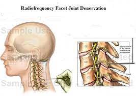Cervical Facet Joint Syndrome E Algos