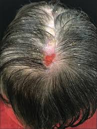 Repeated scratching of the scalp due to itch (usually reversible). Trigeminal Trophic Syndrome Simulating Pityriasis Amiantacea Abstract Europe Pmc