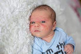 Dalam masa 10hari, ruam pada kulit kepala bayi sembuh dgn herbal blend. 8 Cara Rawatan Untuk Ruam Di Muka Bayi Emergency Baby Care Youbaby