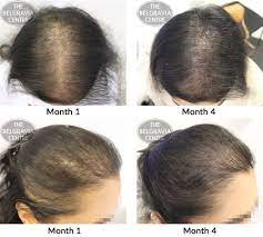 Patches of scaling that spread over the scalp. Hair Growth Success It Actually Works