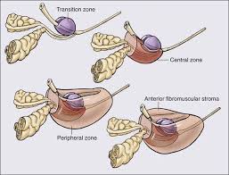 It may grow slowly and it's typically treatable. Prostate Cancer Oncohema Key