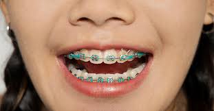 Having your child hold an. Braces With Rubber Bands Purpose And How Long They Stay On