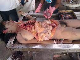 Xxx autopsy pictures