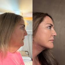 Compression wrap causing neck line