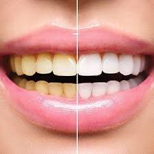 Does blue cross blue shield cover teeth whitening. At Home Teeth Whitening Lincoln Ne Cosmetic Dentist Williamsburg Dental